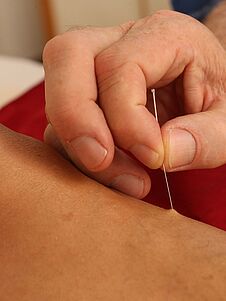 Akupunktur 